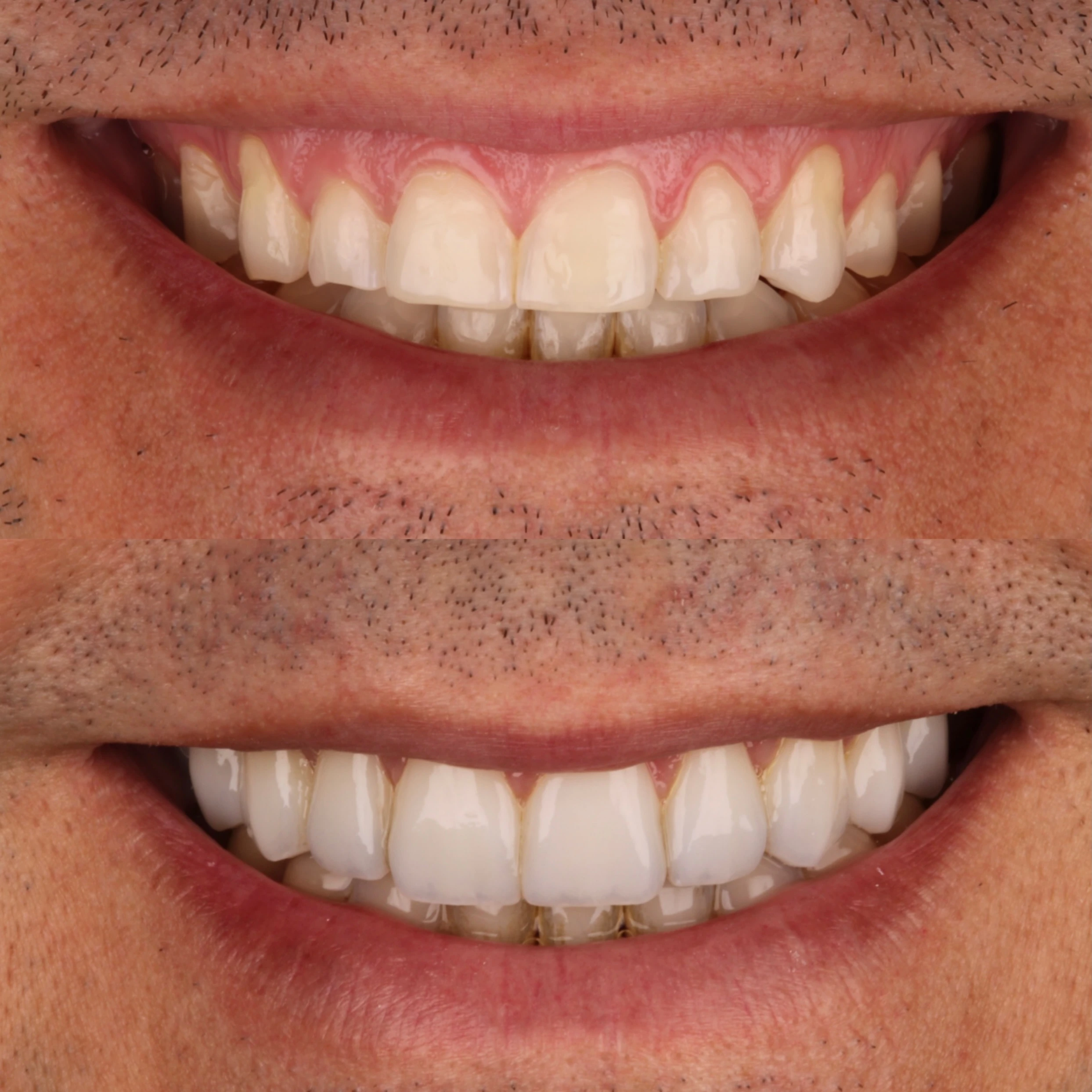 Comparação de sorriso publicada pela Odontoclin em um caso de reabilitação com porcelana.