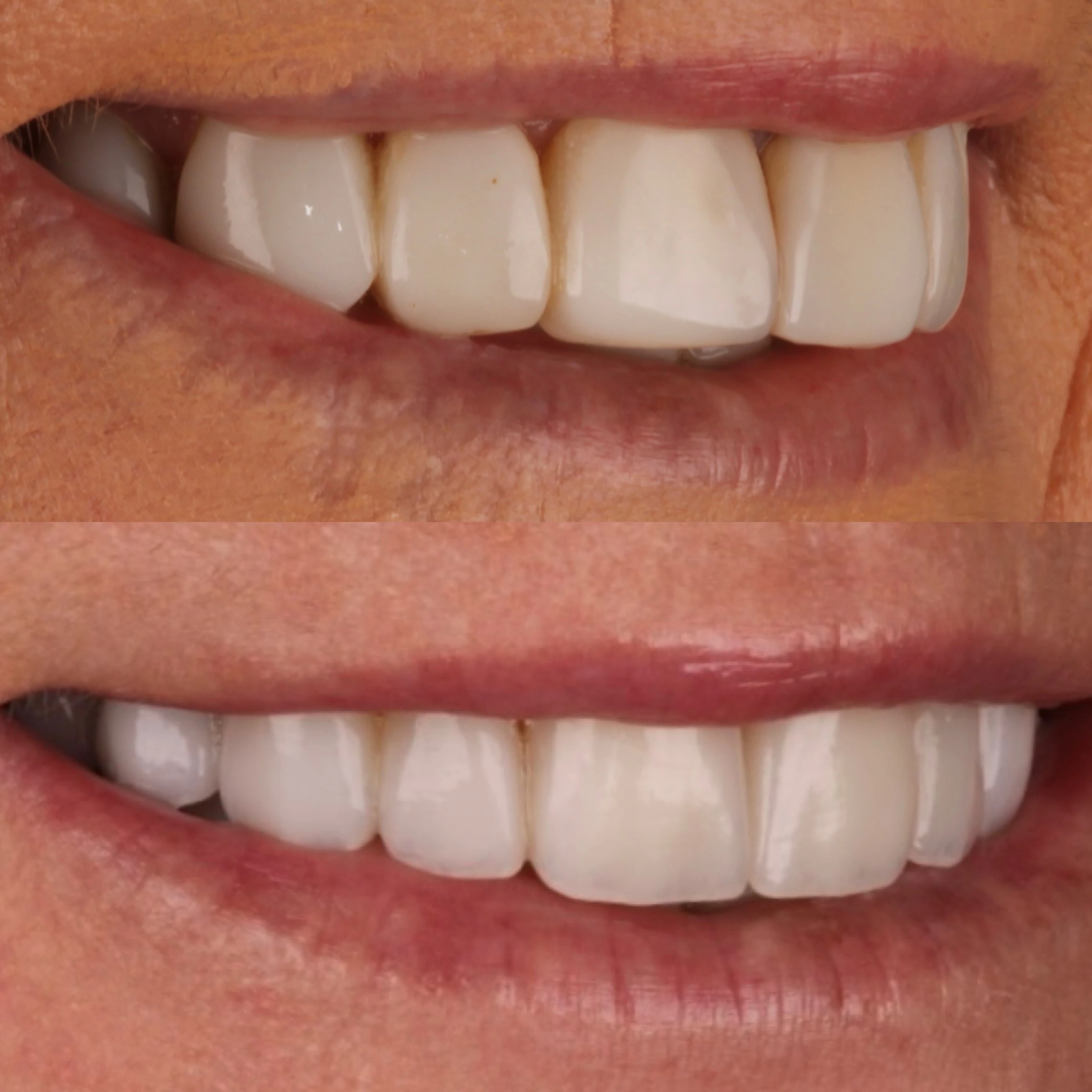 Comparação de sorriso publicada pela Odontoclin em um caso de substituição de lentes de resina por porcelana.