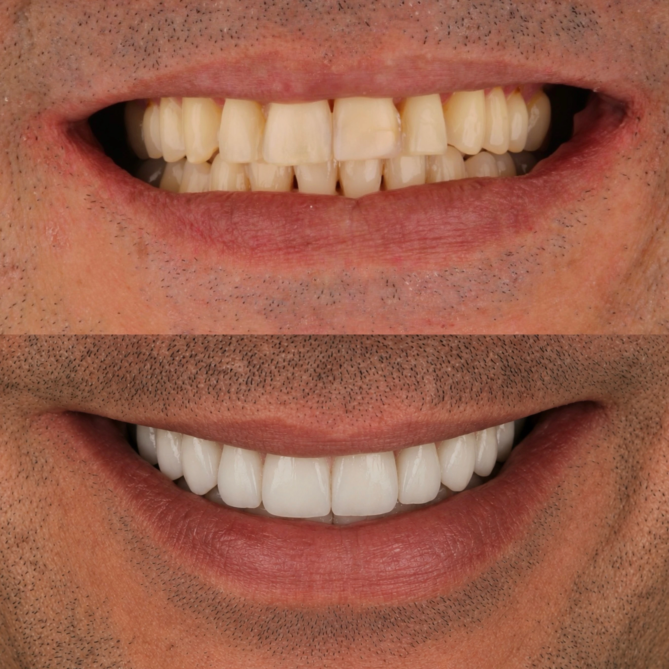 Comparação de sorriso publicada pela Odontoclin em um caso com alinhadores antes de lentes de porcelana.