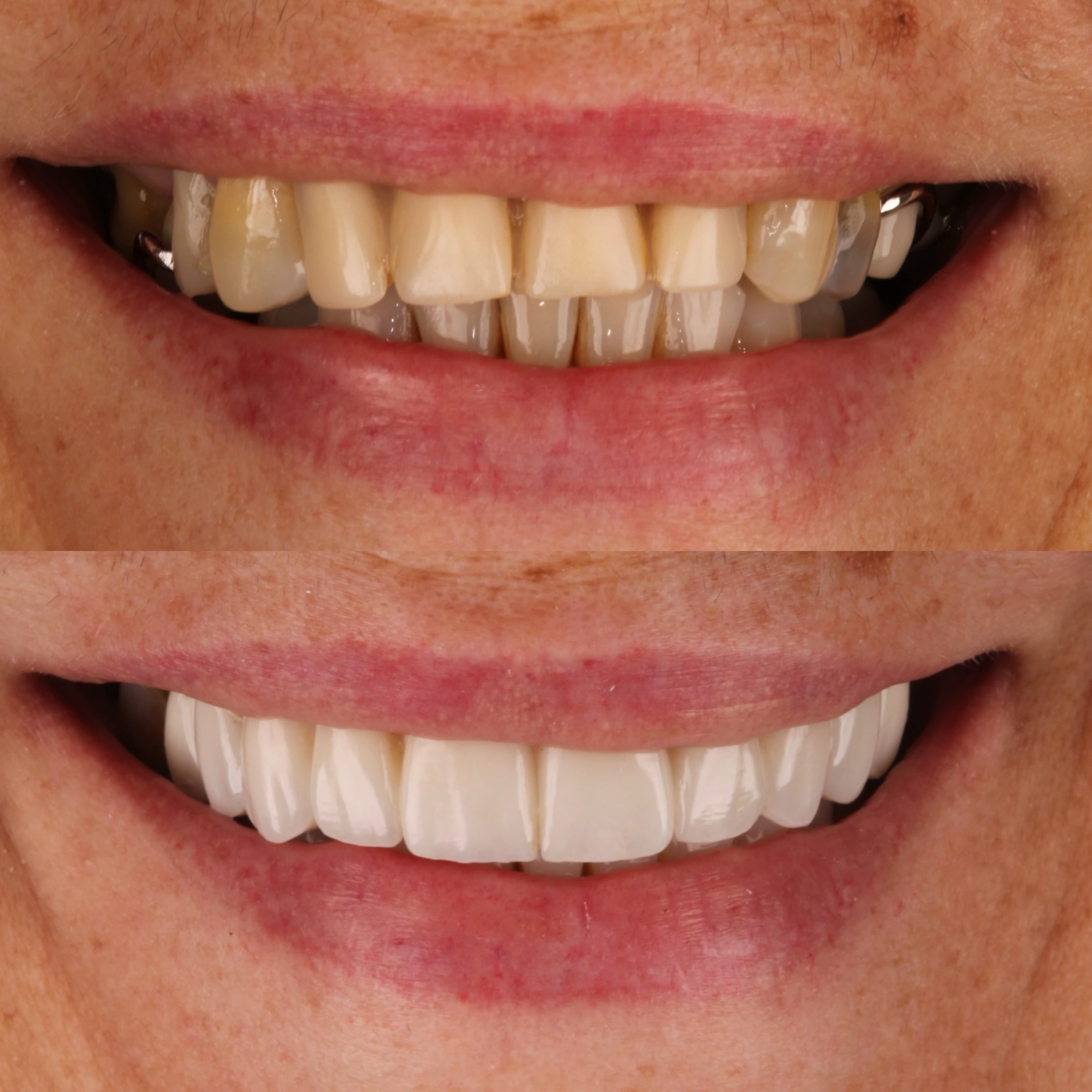 Comparação de sorriso publicada pela Odontoclin, antes e depois.